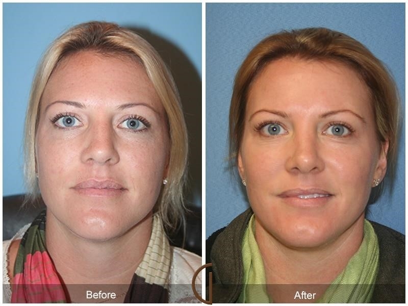 revision rhinoplasty experts