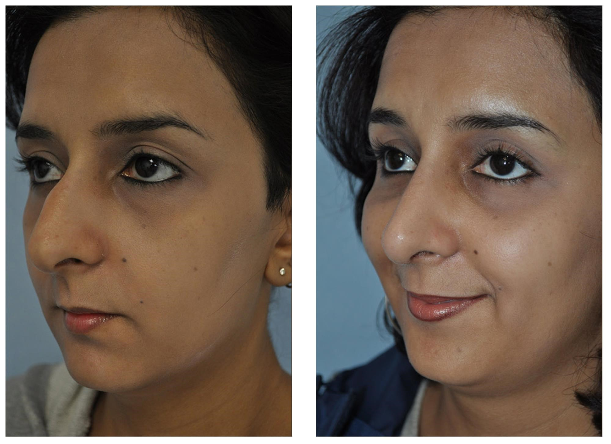 revision rhinoplasty experts